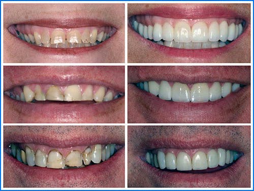 Dental Veneers Edmonton