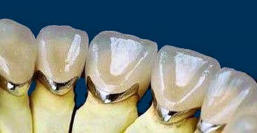 Are Porcelain Fused to Metal Crowns Best for Back Teeth?