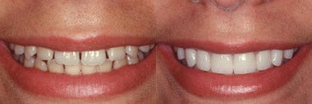 How To Fix A Crooked Tooth Without Braces - Dentist Edmonton - Floss & Gloss Dental