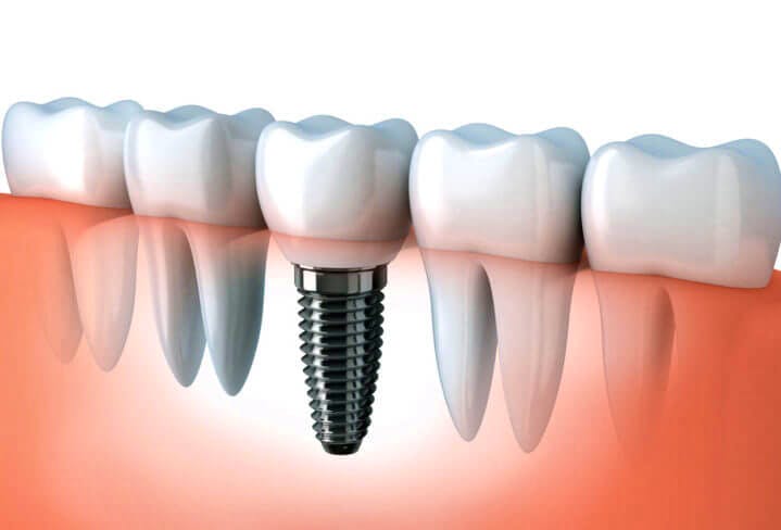 How do Dental Implants Work? - Dentist Edmonton - Floss & Gloss Dental