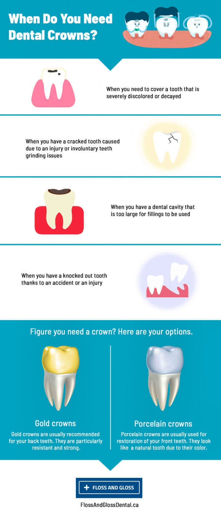 When Do You Need Dental Crowns? - Dentist Edmonton - Floss & Gloss Dental