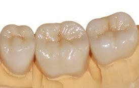 Are Porcelain Fused to Metal Crowns Best for Back Teeth? - Dentist Edmonton - Floss & Gloss Dental