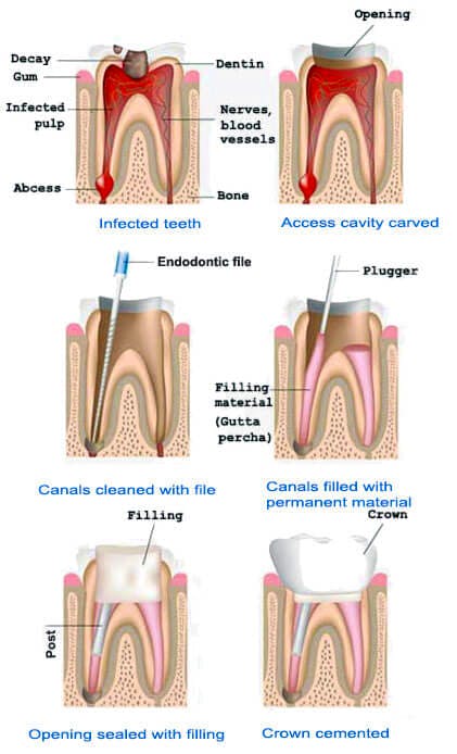 Root Canal Treatment - Floss & Gloss Dental