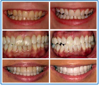 Teeth Whitening - Floss & Gloss Dental